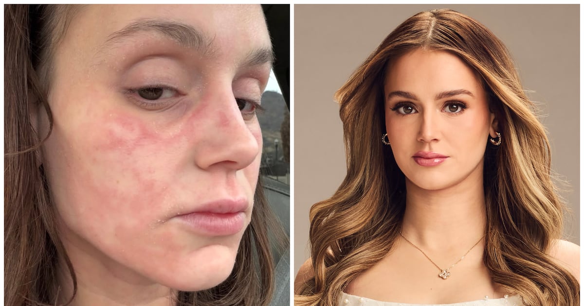 Secret Lives Star Mikayla Matthews Opens Up About Chronic Eczema